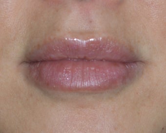Lip Injections after 985741