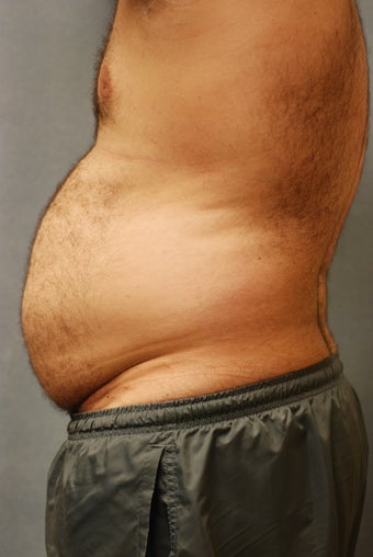 SmartLipo Abs 356457