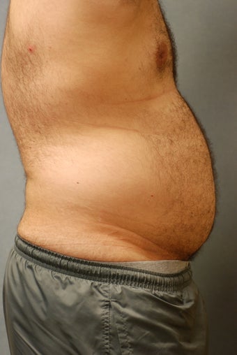 SmartLipo Abs before 356457