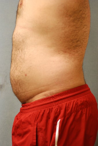 SmartLipo Abs 356457