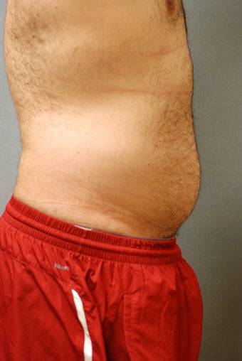 SmartLipo Abs after 356457