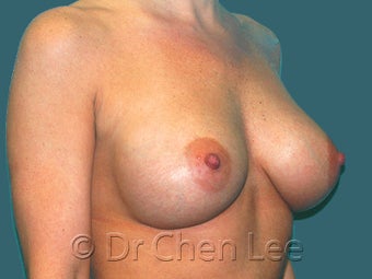 Mild Sag and Volume Loss arising in the Aging Breast 930234