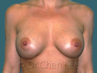 Mild Sag and Volume Loss arising in the Aging Breast after 930234
