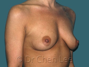 Mild Sag and Volume Loss arising in the Aging Breast 930234