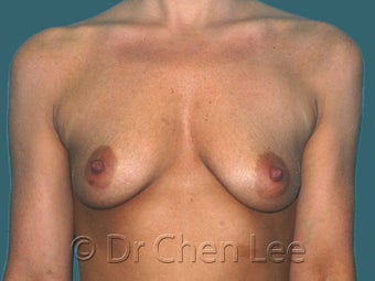 Mild Sag and Volume Loss arising in the Aging Breast before 930234