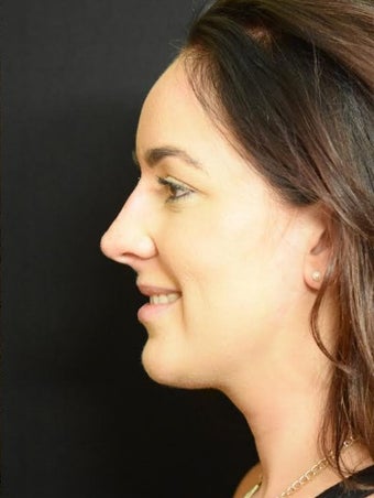 25-34 year old woman treated with Non Surgical Nose Job after 2728225