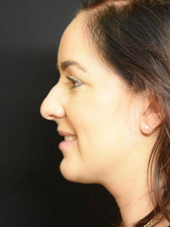 25-34 year old woman treated with Non Surgical Nose Job before 2728225