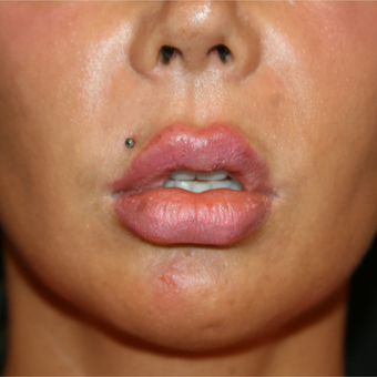 35-44 year old woman treated with Lip Lift before 3648605
