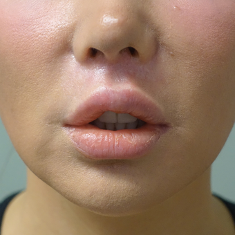 35-44 year old woman treated with Lip Lift after 3648605