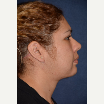 25-34 year old woman treated with Neck Lift after 3490138