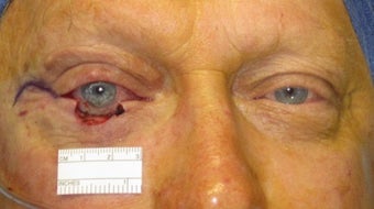 Eyelid skin cancer surgery before 875946