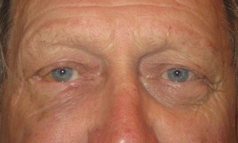 Eyelid skin cancer surgery after 875946