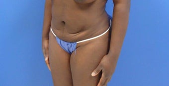 32 y.o. – female – Wise pattern mastopexy with abdominoplasty (mommy makeover) before 3401310