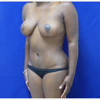 32 y.o. – female – Wise pattern mastopexy with abdominoplasty (mommy makeover) after 3401310