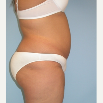 20 year old woman treated with Tummy Tuck after 3375472