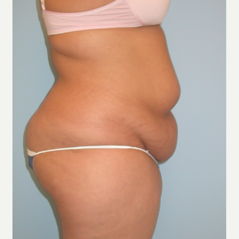 20 year old woman treated with Tummy Tuck before 3375472