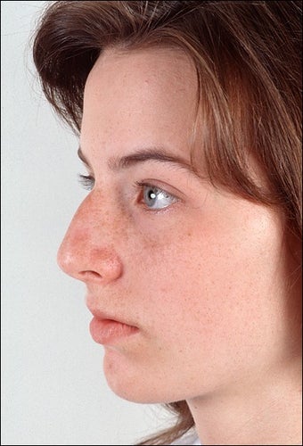 Rhinoplasty before 1023273