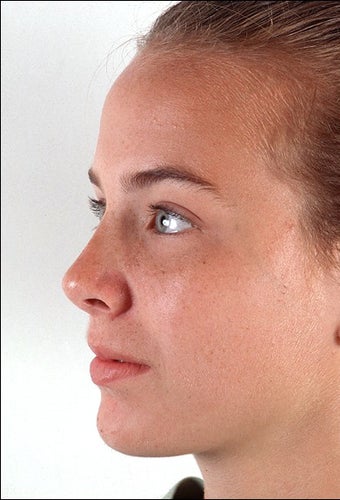 Rhinoplasty after 1023273