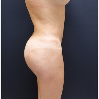 35-44 year old woman treated with Butt Augmentation after 3234502