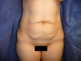 32 yo woman underwent TT with mesh exclusively by Gary Horndeski MD before 1235643