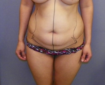 Tummy Tuck before 1191503