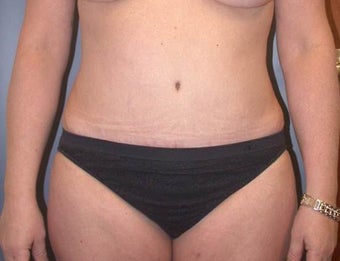 41 year old female who had tummy tuck with liposuction after 1110923