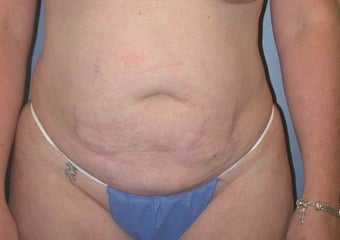 41 year old female who had tummy tuck with liposuction before 1110923
