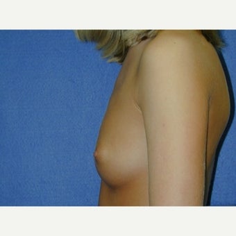 Under 25 year old woman ,weight 100-115 lbs treated with Breast Augmentation before 1711634