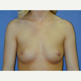 Under 25 year old woman ,weight 100-115 lbs treated with Breast Augmentation 1711634