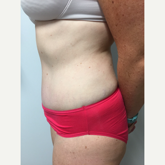 41 year old woman treated with Tummy Tuck and Liposuction after 3822283