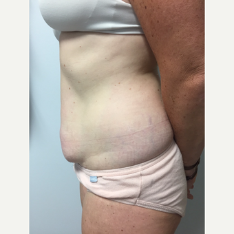 41 year old woman treated with Tummy Tuck and Liposuction before 3822283