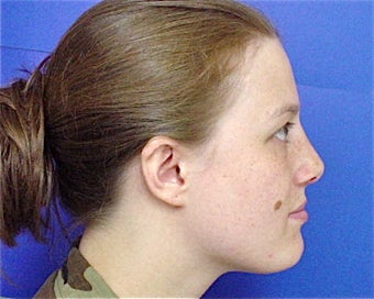 Septoplasty and Rhinoplasty, Nose surgery after 680274