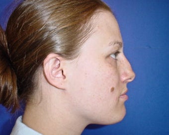 Septoplasty and Rhinoplasty, Nose surgery before 680274