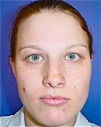 Septoplasty and Rhinoplasty, Nose surgery 680274