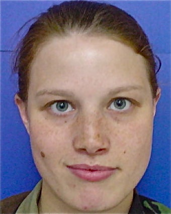 Septoplasty and Rhinoplasty, Nose surgery 680274