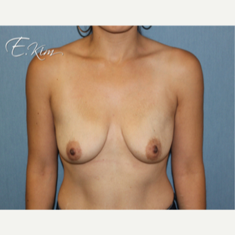 25-34 year old woman treated with Breast Lift with Implants before 3102629