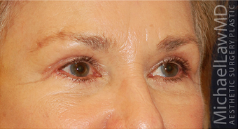 Eye Bag Surgery 886859