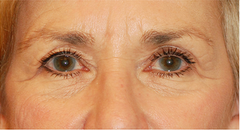 Eye Bag Surgery before 886859
