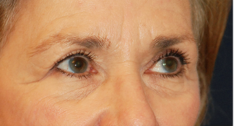 Eye Bag Surgery 886859