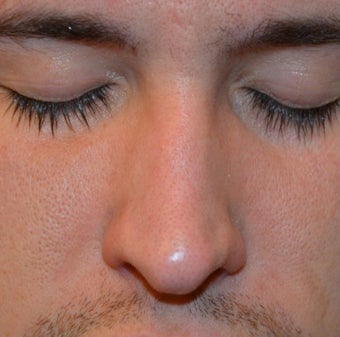 23 Year Old Male Treated For Nasal Deformity 1447477