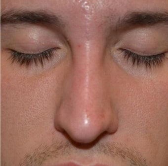 23 Year Old Male Treated For Nasal Deformity 1447477