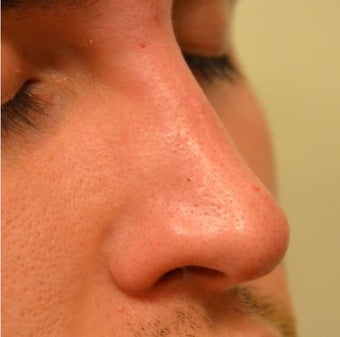 23 Year Old Male Treated For Nasal Deformity after 1447477