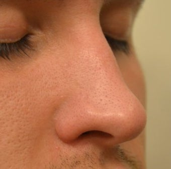 23 Year Old Male Treated For Nasal Deformity before 1447477
