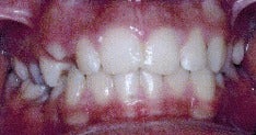 17 or under year old woman treated with Braces before 3036887