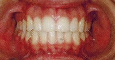 17 or under year old woman treated with Braces after 3036887