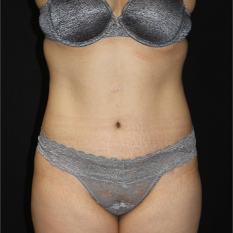 25-34 year old woman treated with Tummy Tuck after 3853726