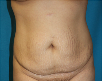 25-34 year old woman treated with Tummy Tuck before 3853726