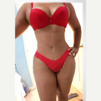 34 year old woman treated with tummy tuck, liposculpture, after 4 months post-op after 3176013