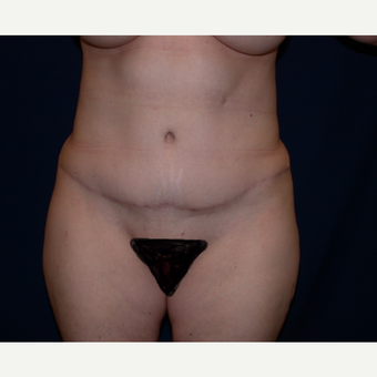 45-54 year old woman treated with Tummy Tuck after 3345084