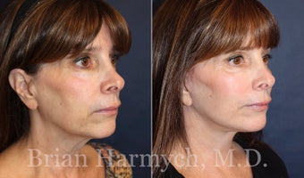 62 year-old female before and 3.5 months after Facelift and Fat Transfer (Autologous Fat Transplant) before 3445866
